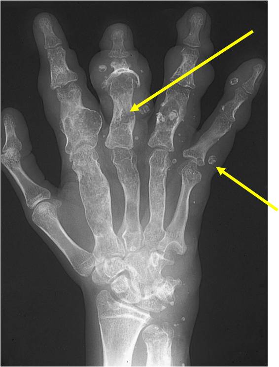 Plain X-Ray of Hand: Maffucci Syndrome 