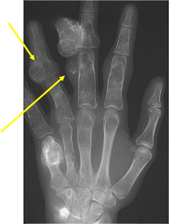Plain X-Ray of Hand: Maffucci Syndrome