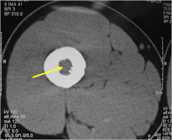 CT Scan: Ewing Sarcoma of Right Femur
