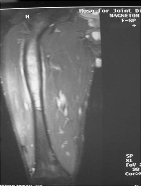 MRI T2 Weighted Image: Ewing Sarcoma of Right Proximal Femur
