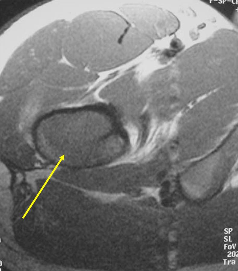 MRI T1 Weighted Axial Image: Ewing Sarcoma of Right Proximal Femur