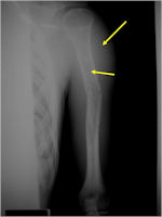 X-ray: Ewing Sarcoma of Left Humerus Metadiaphysis