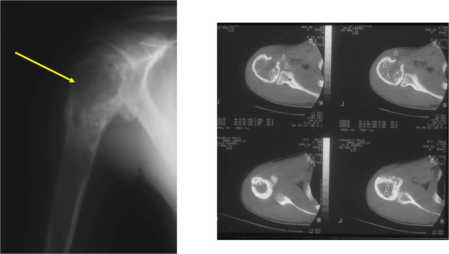 X-ray/CT Scan: Ewing Sarcoma of Right Proximal Humerus
