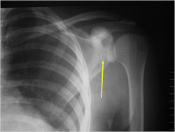 X-ray: Ewing Sarcoma of Scapula