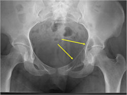 X-ray: Ewing Sarcoma of Left Acetabulum and Superior Pubic Ramus