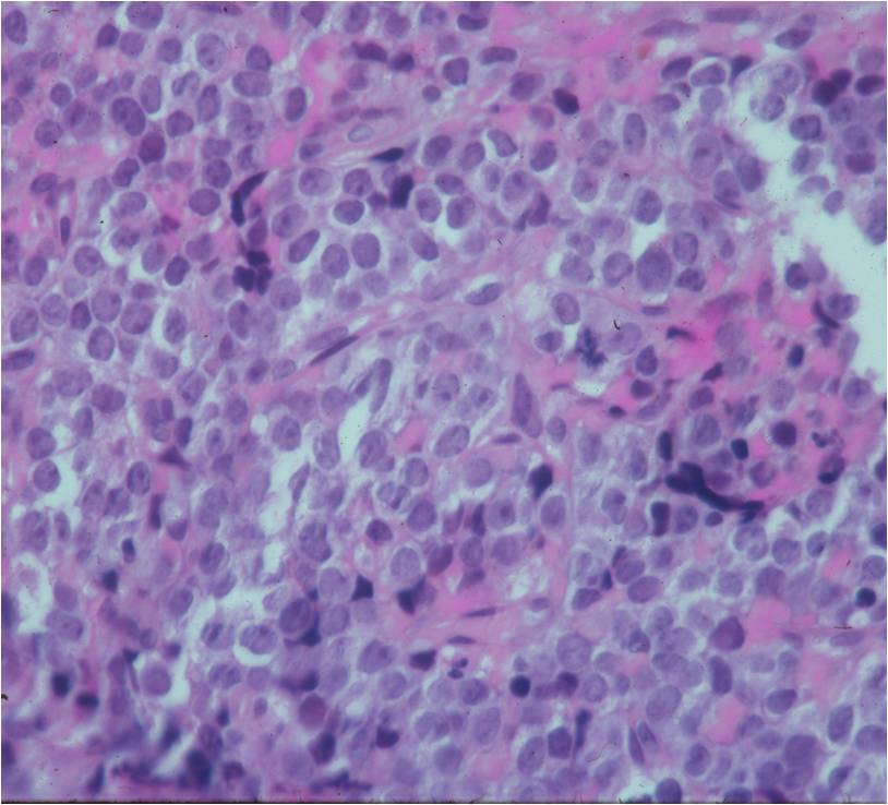 Microscopic Pathology: Ewing Sarcoma