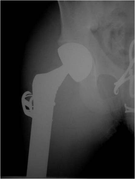 X-ray: Upper Portion of Proximal Femur Tumor Prosthesis
