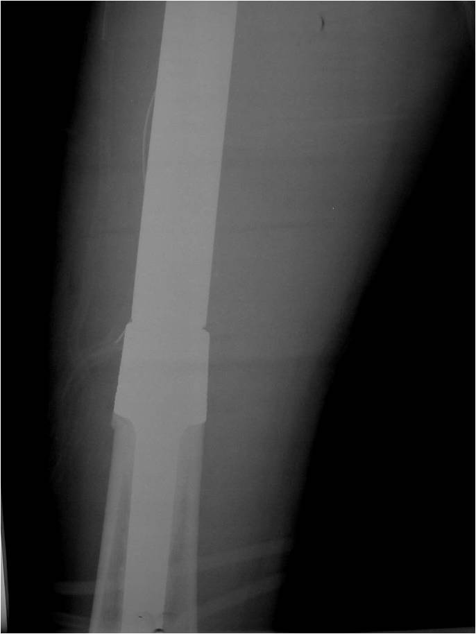 Lower Portion of Proximal Femur Tumor Prosthesis, Prosthesis Cemented into Medullary Canal