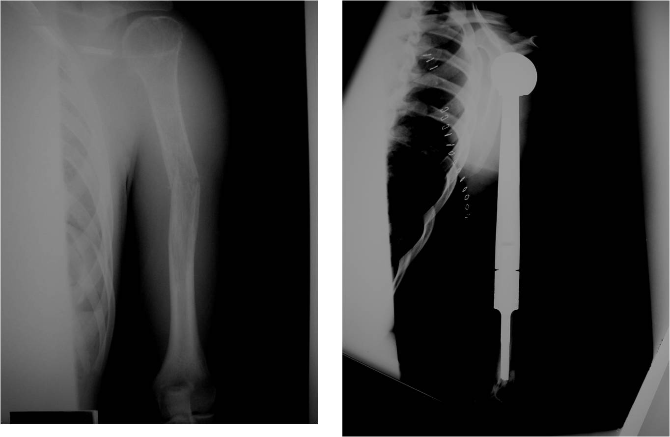 Ewing Sarcoma: Prosthetic Reconstruction of Proximal Humerus with<br />Proximal Humerus Tumor Prosthesis Limb Sparing Surgery