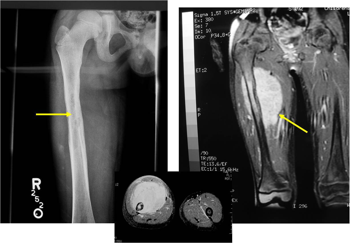 X-ray/MRI: Ewing Sarcoma of Diaphysis of Femur