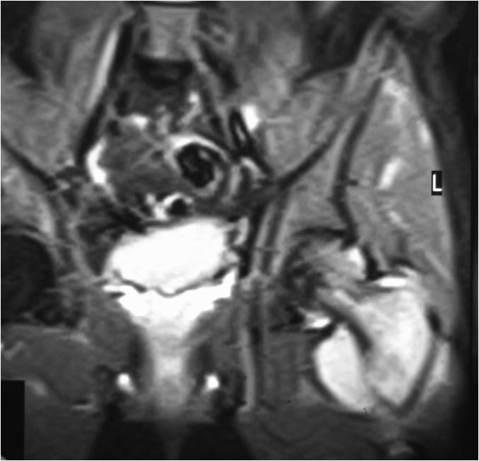 MRI: Primary Lymphoma of Bone