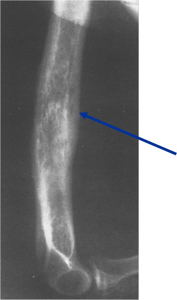 X-ray: Primary Lymphoma of Distal Humerus, Permeative Lesion