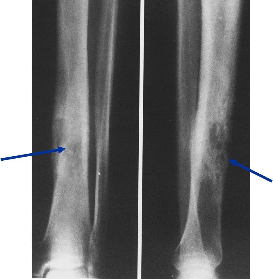 X-ray: Primary Lymphoma of Tibia