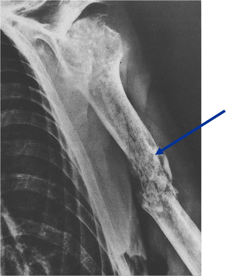 X-ray: Primary Lymphoma of Humerus