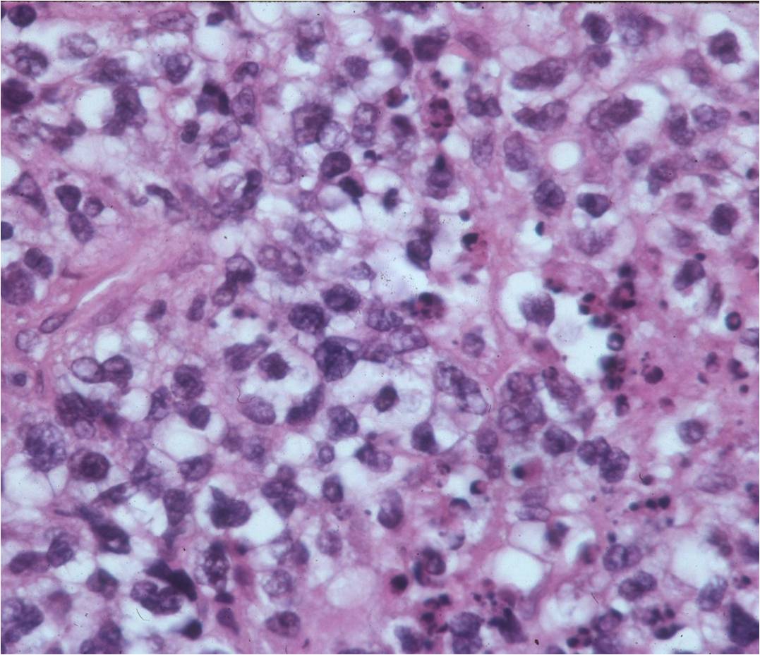 Microscopic Pathology: Lymphoma