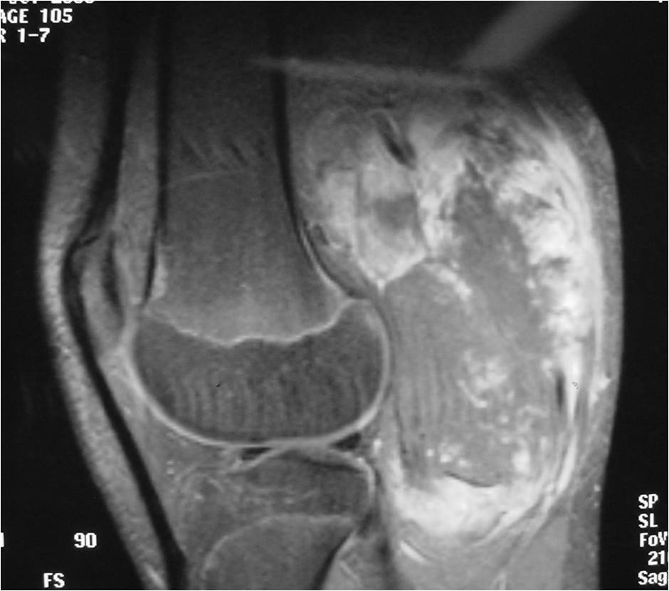 MRI with Gadolinium: Extraskeletal Mesenchymal Chondrosarcoma Extensive Necrosis Demonstrated indicative of High Grade Tumor