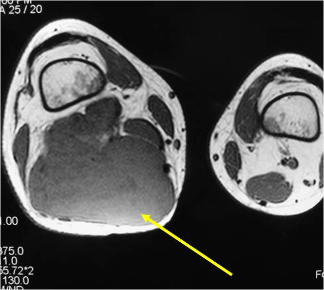 MRI: Extraskeletal Mesenchymal Chondrosarcoma