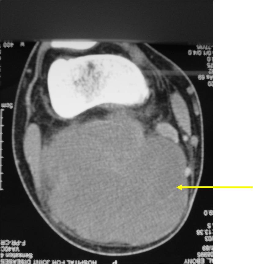 CT Scan: Extraskeletal Mesenchymal Chondrosarcoma of Popliteal Fossa No Mineralization Detected