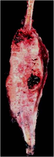 Mesenchymal Chondrosarcoma, gross pathology