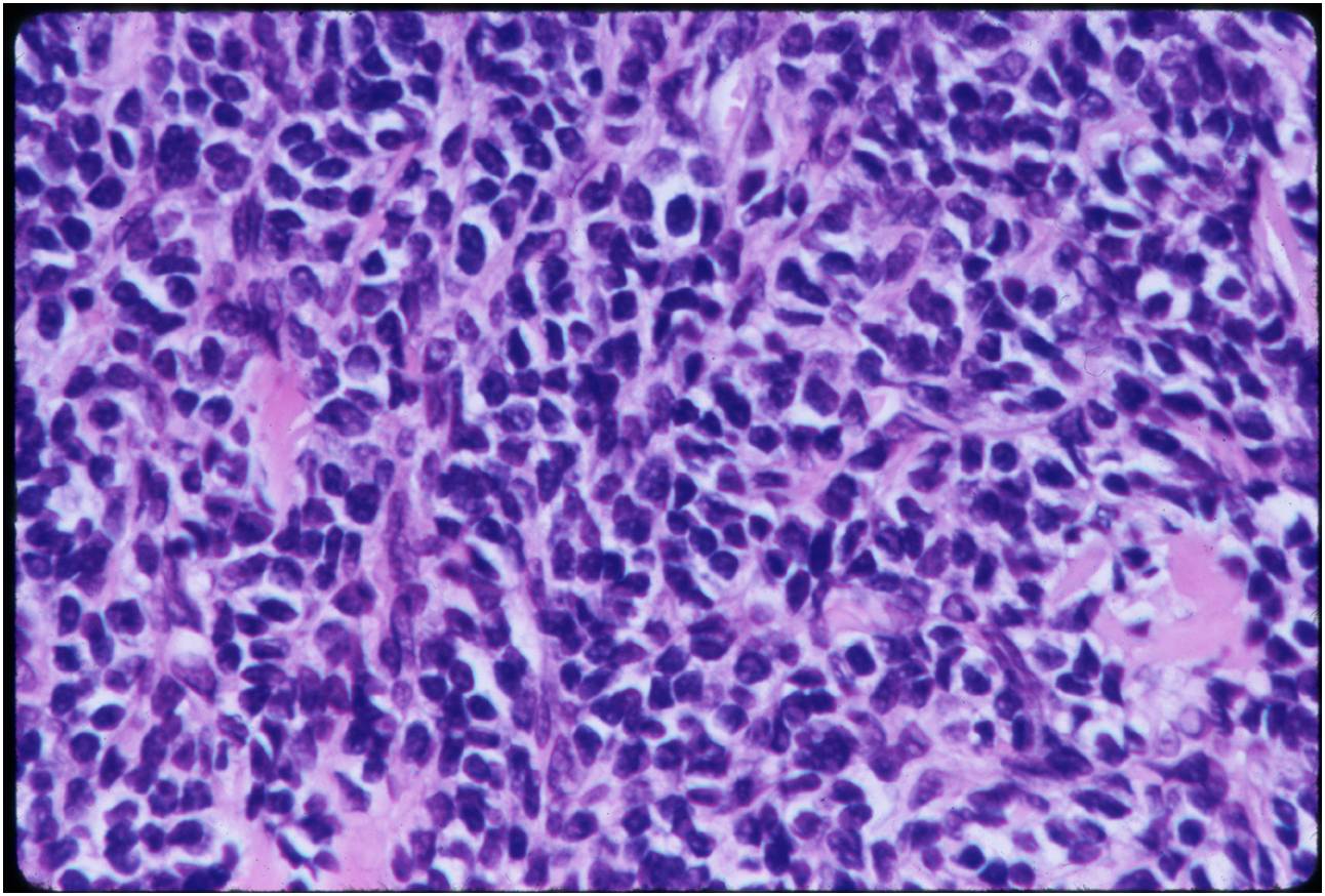 Mesenchymal (Small Round Blue Cell) Component Hemagiopericytoma-like Pattern of Blood Vessels