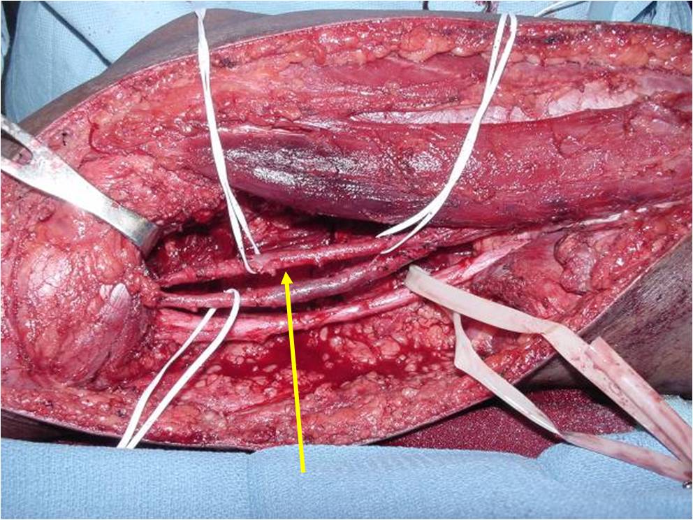 Popliteal Artery Re-anastomosed