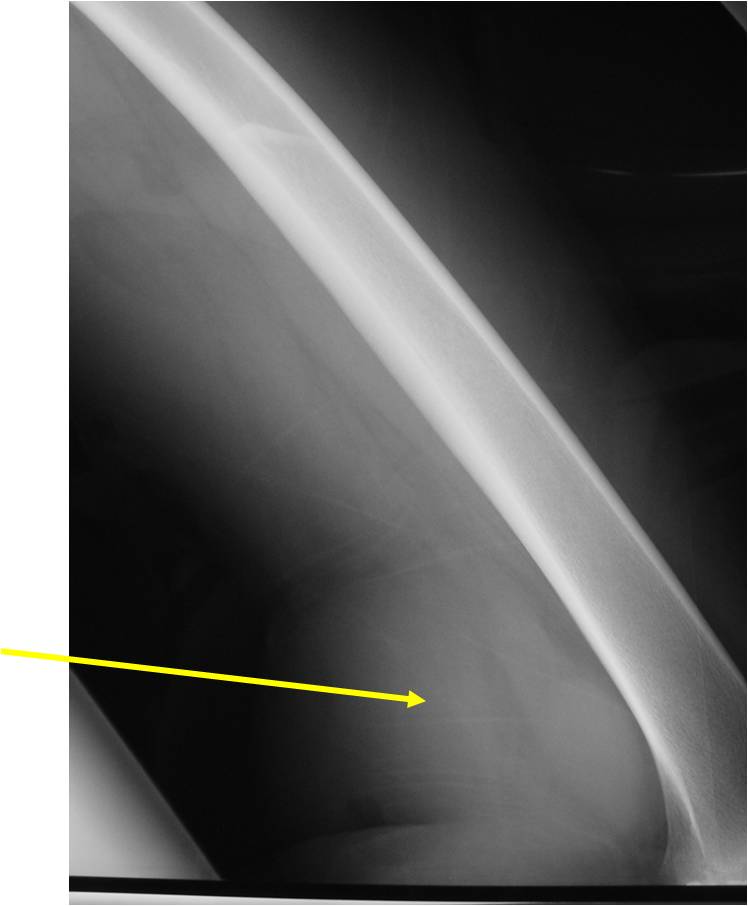 Plain X-ray: Extraskeletal Mesenchymal Chondrosarcoma of Popliteal Fossa