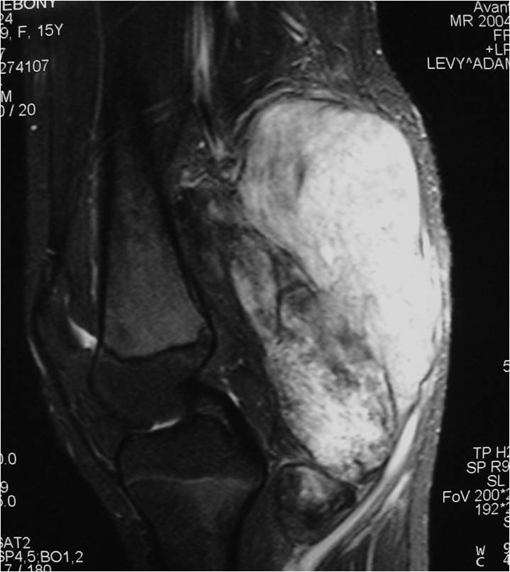 MRI: Extraskeletal Mesenchymal Chondrosarcoma of Popliteal Fossa