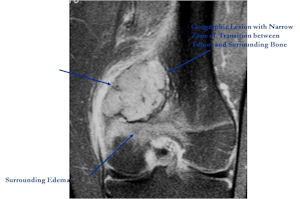 MRI: T2 Weighted of Osteoblastoma of Distal Femur