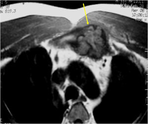 MRI: T2 Weighted Image of Osteoblastoma of Sternum with Surrounding Edema