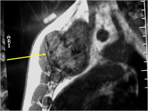 MRI: T1 Weighted Image Osteoblastoma of Sternum