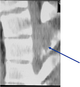 Osteoblastoma of Spine