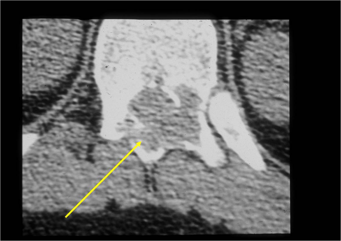 CT Scan Osteoblastoma of Spine Posterior Elements
