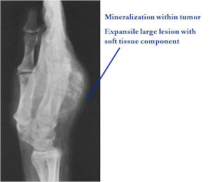 Plain X-Ray: Aggressive Osteoblastoma of a Hand Metacarpal