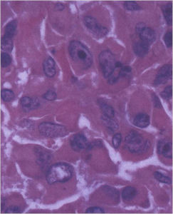 Epithelioid Osteoblasts