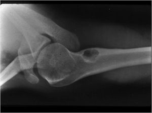 Plain X-ray: Osteoblastoma of Proximal Humerus