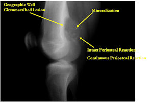 Plain X-Ray: Osteoblastoma of Distal Femur