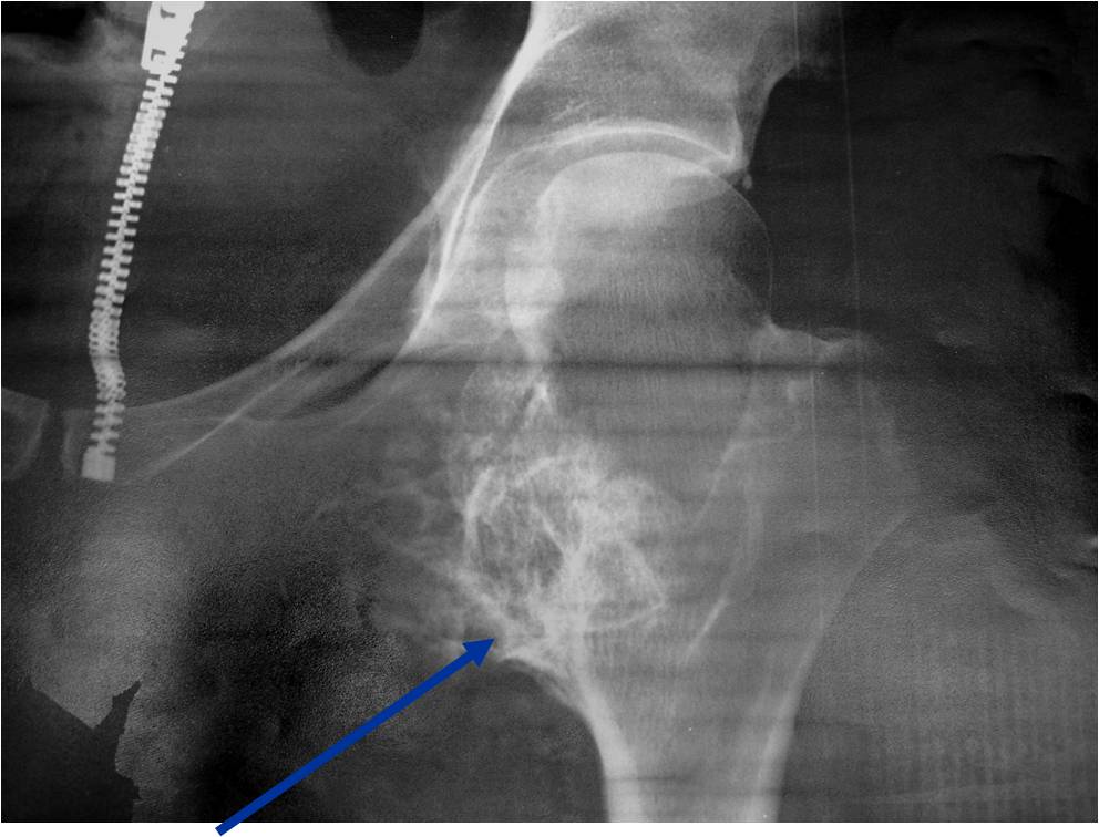 X-ray: Left Proximal Femur Osteochondroma