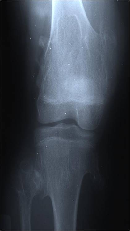 X-ray: Multiple Hereditary Osteochondromas of Distal Femur and Proximal Tibia/Fibula