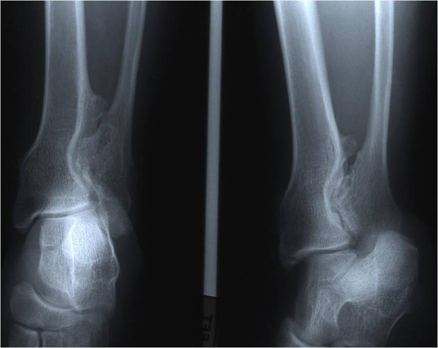 X-Ray: Multiple Hereditary Osteochondromas of Distal Fibula