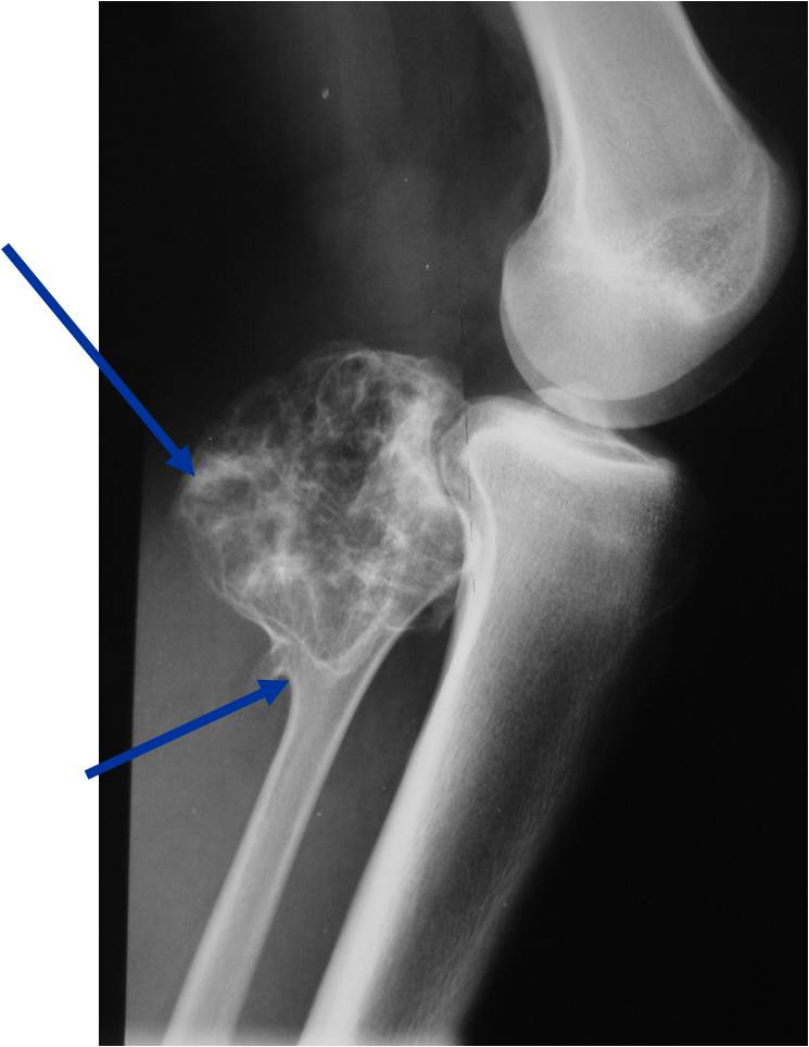 Proximal Fibula Osteochondroma: Cortical-Medullary Continuity; Ring and Arc Calcifications