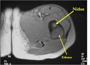 MRI: Osteoid Osteoma