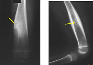 Plain X-ray: Osteoid Osteoma of Femur