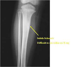 X-Ray: Osteoid Osteoma of Tibia