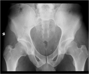 X-ray: Osteoid Osteoma of Left Acetabulum  (Not Detectable on Plain X-ray)