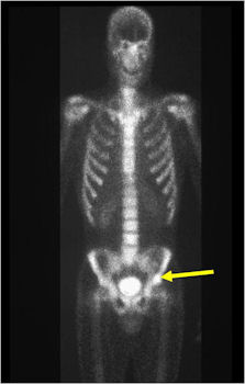 Bone Scan: Osteoid Osteoma of Left Acetabulum