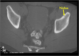 CT Scan: Osteoid Osteoma of Left Acetabulum (The nidus is a few millimeters)