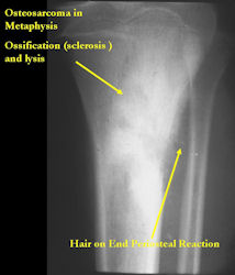 X-RAY:  Osteosarcoma of Proximal Tibia