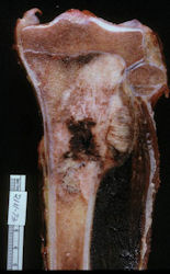 Gross Pathology:  Conventional Osteosarcoma of Proximal Tibia
