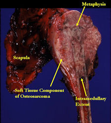 Gross Pathology:  Osteosarcoma of Proximal Humerus