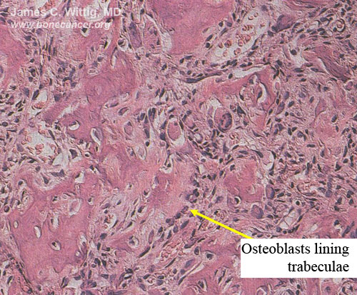 Microscopic Pathology:  Osteoblastoma (click on image to enlarge)  Well-formed trabeculae lined by osteoblasts 